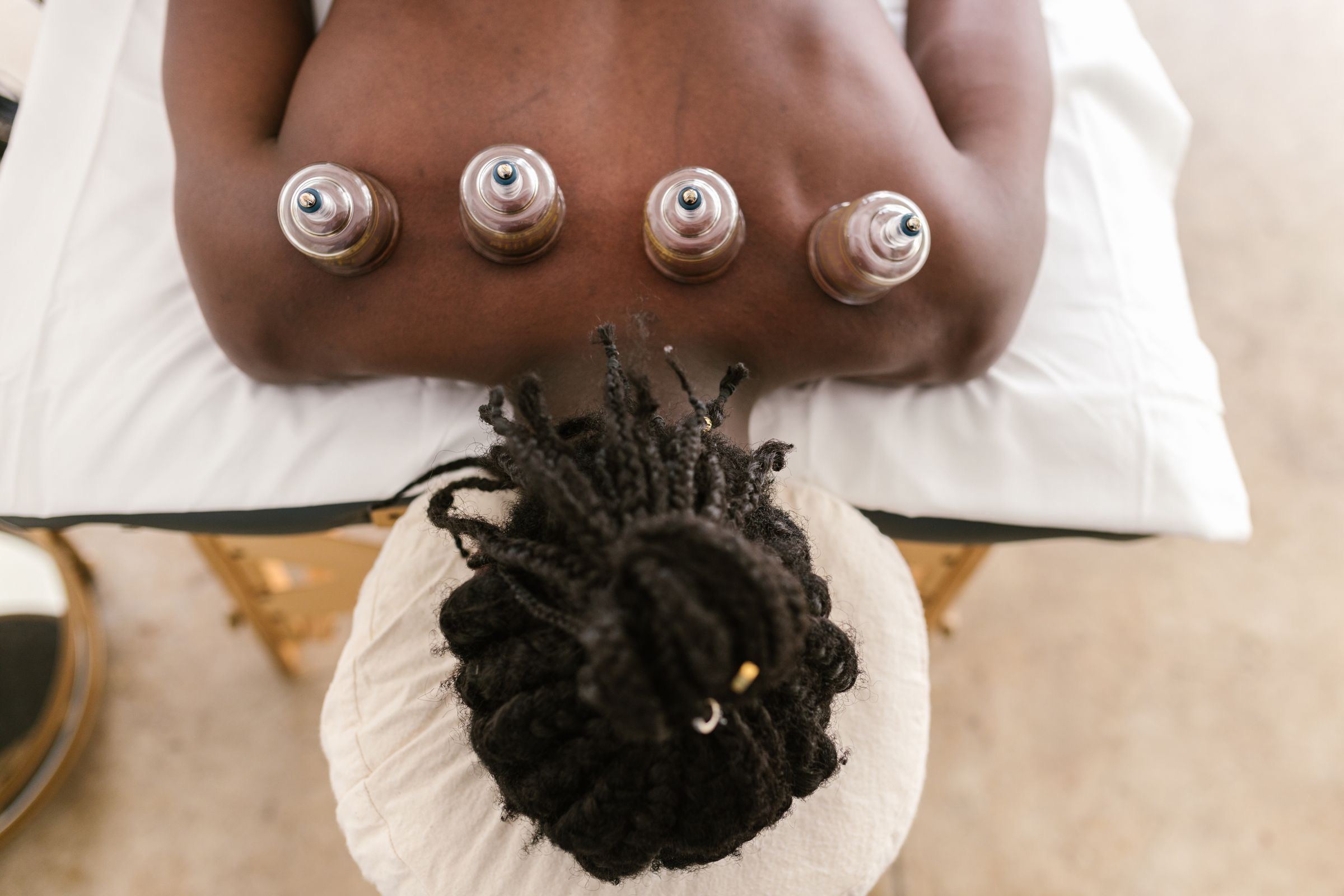 Glass cups placed along the upper back during cupping therapy
