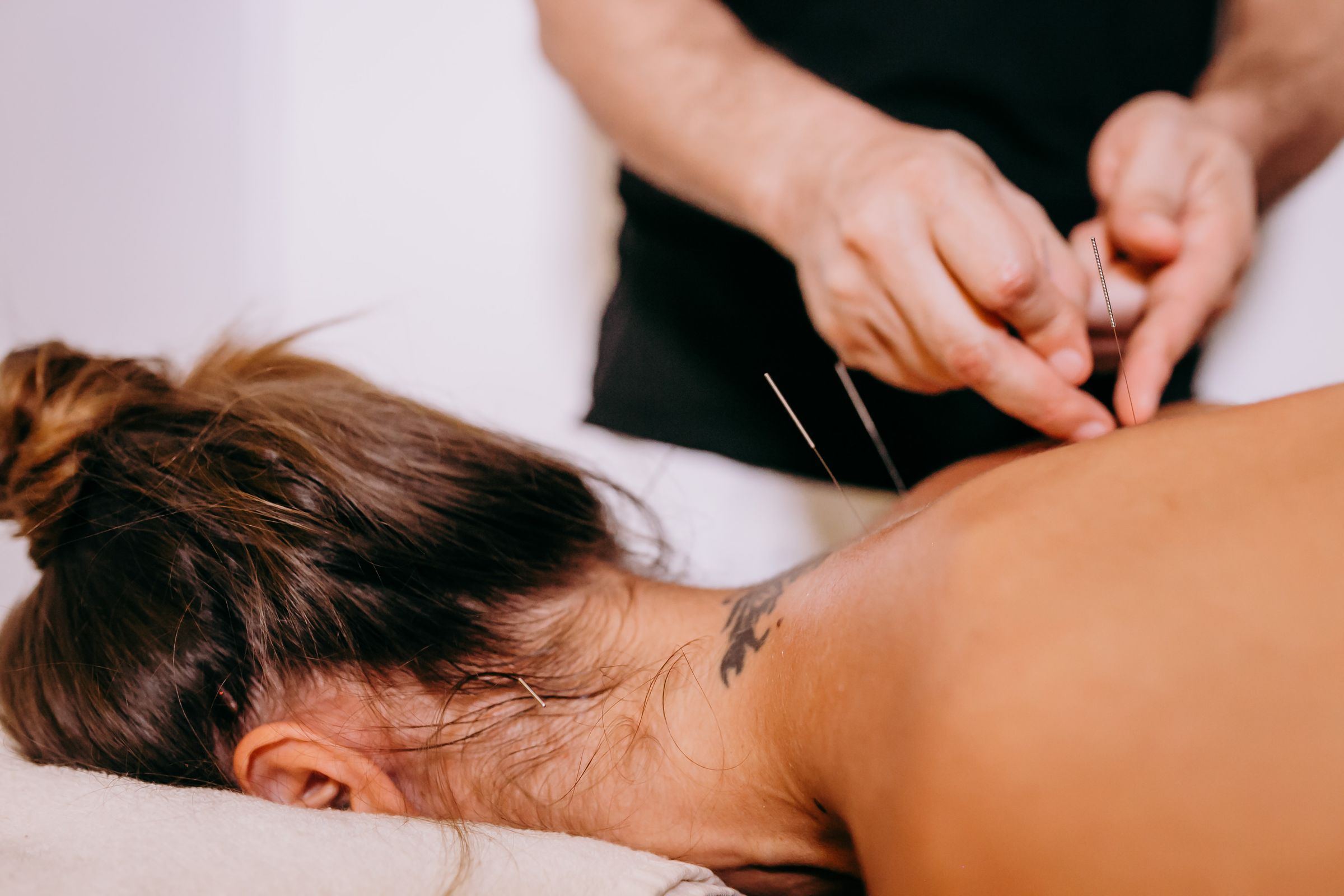 Acupuncture needles placed along the neck and upper back
